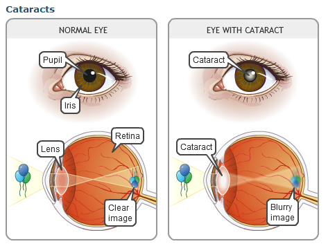 Subcapsular cataract steroid